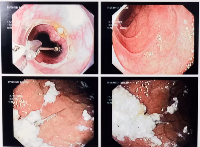 Đang điều trị răng miệng, thanh niên nuốt cả kim nha khoa vào bụng