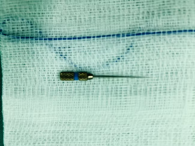 Dị vật sắc nhọn được lấy ra cho bệnh nhân. (Ảnh: BVCC).