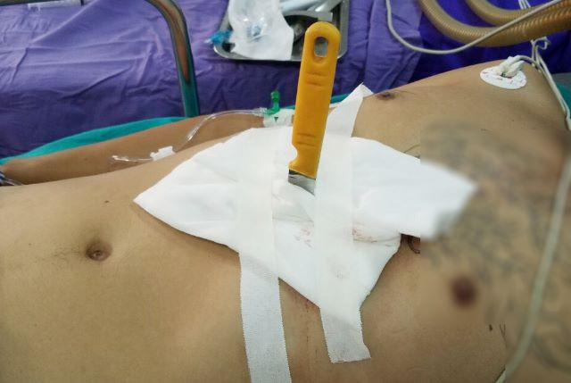 Con dao đâm thấu bụng người bệnh. Con dao đâm thấu bụng người bệnh.