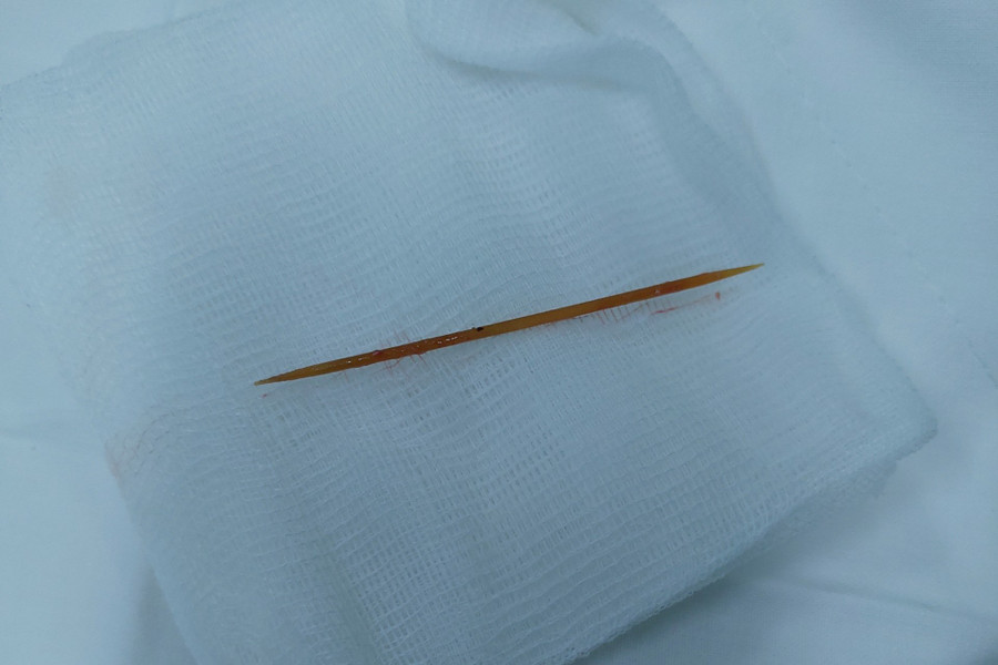 Chiếc tăm lấy ra từ bụng người bệnh. Chiếc tăm lấy ra từ bụng người bệnh.