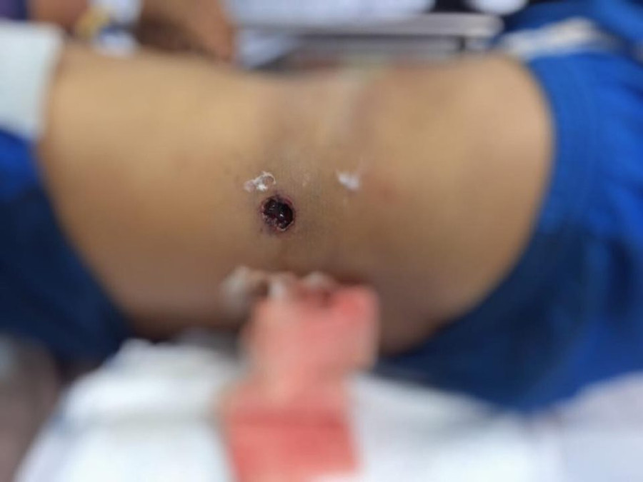 Vết thương xuyên thấu bụng.