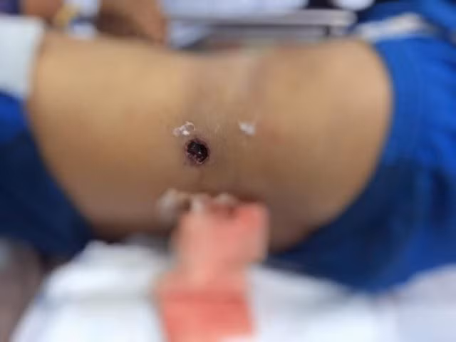 Đeo súng săn đi xe máy, nam thanh niên suýt mất mạng vì cướp cò, đạn xuyên thấu bụng khi ngã