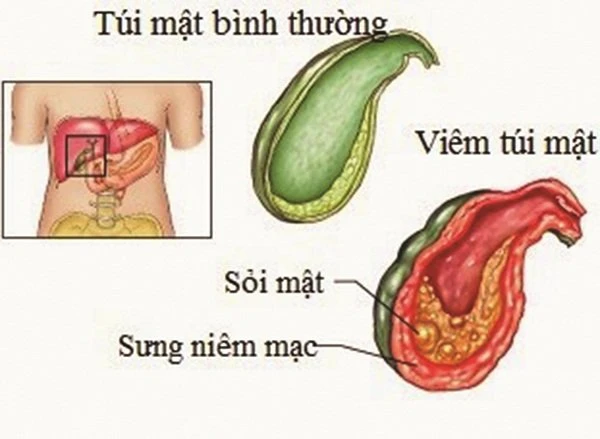 Bệnh lý sỏi mật chưa có xu hướng giảm.