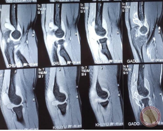 Hình ảnh phim chụp (BVCC). Hình ảnh phim chụp (BVCC).