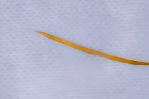 Xương cá dài 5cm được phát hiện khi bệnh nhân đi khám.