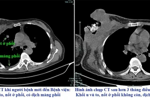 Đắp thuốc nam để điều trị, người bệnh bị vỡ, loét khối u. (Ảnh: BVCC)