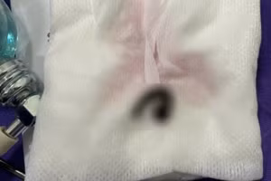 Bé trai bị mũi ký sinh trong tai, mũi, họng do tắm suối.