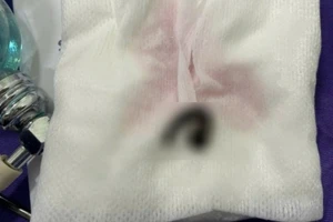 Bé trai bị mũi ký sinh trong tai, mũi, họng do tắm suối.