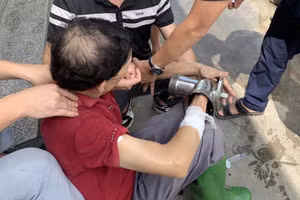 Người đàn ông nhập viện cấp cứu với máy xay thịt dính trên tay phải.