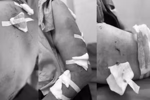 Cụ bà 77 tuổi bị đa chấn thương do đàn chó cắn.