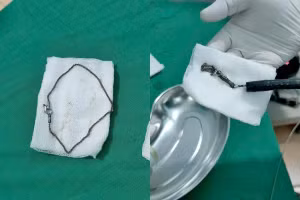 Sợi dây chuyền bé gái nuốt phải được các bác sĩ lấy ra.