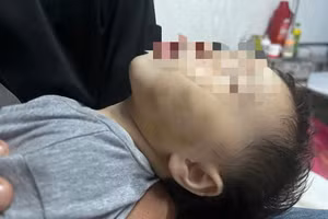 Bé D., 9 tháng tuổi bị bầm 2 bên má. (Ảnh: TT)