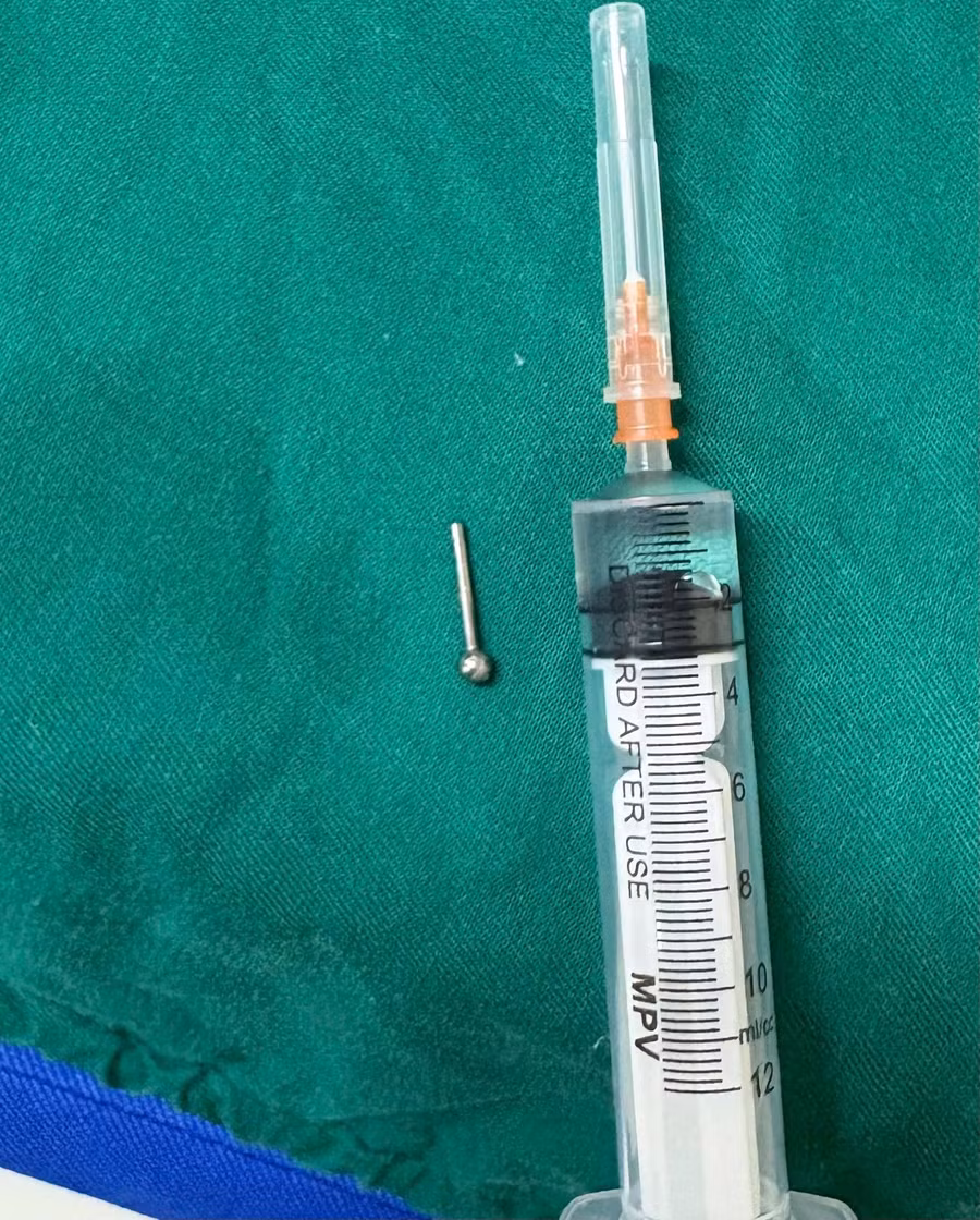 Chiếc khuyên lưỡi được gắp ra khỏi dạ dày bệnh nhân. Ảnh: BVCC