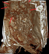 phat-hien-soc-thai-nhi-trong-tu-cung-xac-uop-ba-ngon-o-peru-3.jpg