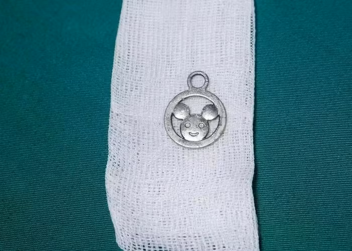 Dị vật bị mắc phía trên thực quản được lấy ra, đảm bảo an toàn cho bé Lý Đ.Đ.