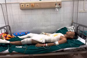 Em Hồ Sỹ Vinh bị bỏng toàn thân do dòng điện cao thế phóng vào người.