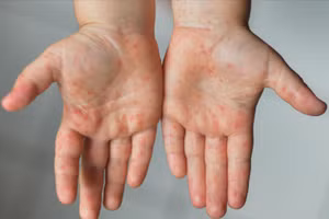 Hình ảnh điển hình của bệnh tay chân miệng với các nốt phát ban ở tay, chân và vùng miệng, thường gặp ở trẻ nhỏ. Ảnh minh hoạ.