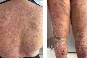 Tổn thương vảy nến lan toả ở người bệnh. Ảnh: BVCC