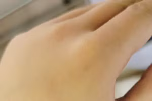  Bệnh nhi được chẩn đoán viêm tấy phần mềm bàn tay trái do chuột cắn. Ảnh: BVCC