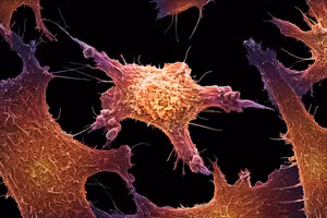 Các tế bào khối u (trong hình là tế bào ung thư vú) giải phóng các mảnh ADN vào dòng máu.