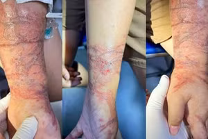 Trẻ tổn thương da do ôm sứa lúc tắm biển. Ảnh: BVCC