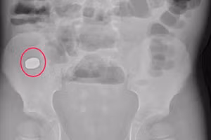 Dị vật nam châm (vùng khoanh tròn). Ảnh: BVCC