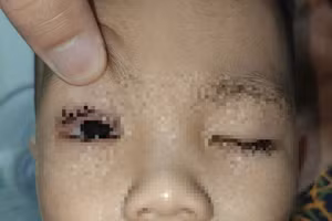 Các bác sĩ đã cho trẻ sử dụng kháng sinh, chống viêm, dưỡng giác mạc. Ảnh: BVCC