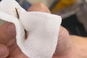 Hình ảnh con rết sau khi được các bác sĩ lấy ra trong ống tai bệnh nhân. Ảnh: BVCC