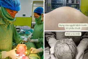 Các bác sĩ phẫu thuật lấy khối u cho bệnh nhân. Ảnh: BVCC