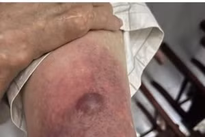 Bệnh nhân nhập viện trong tình trạng vùng đùi phải sưng to, căng tức, xuất hiện nhiều nốt phỏng nước chứa dịch màu nâu đen. Ảnh: BVCC 