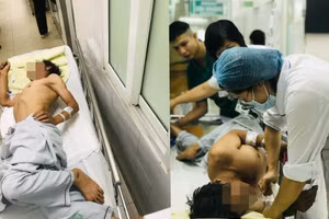 Bệnh nhân uốn ván điều trị tại Trung tâm Bệnh nhiệt đới, Bệnh viện Bạch Mai. Ảnh: BVCC