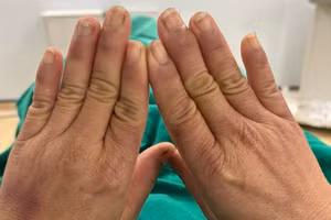 Bàn tay của người bệnh bị tím tái, ngón tay trắng nhợt mỗi khi chạm vào nước. Ảnh: BVCC