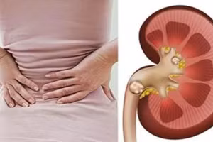 Sỏi thận gây ảnh hưởng nhiều đến chất lượng cuộc sống. Ảnh minh họa: INT