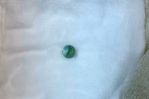 Viên bi sau khi được gắp ra khỏi dạ dày của bệnh nhi. Ảnh: BVCC