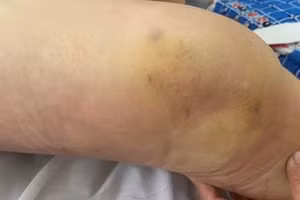 Khớp nhiễm khuẩn, viêm tấy lan tỏa cẳng chân. Nguồn: Bệnh viện Đa khoa tỉnh Thái Bình