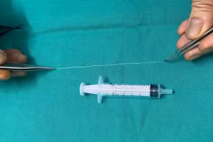 Con giun 14cm được lấy ra từ mắt bệnh nhân. Ảnh: BVCC