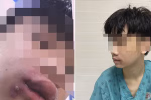 Bệnh nhân nhập viện do nhiễm khuẩn huyết sau nặn mụn. Ảnh: BVCC