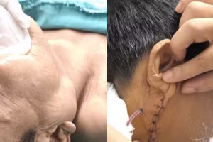 Hình ảnh bệnh nhân trước và sau phẫu thuật. Ảnh: BVCC