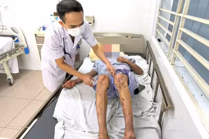 Mù tạm thời, bỏng nặng do tiếp xúc silicon chống dột