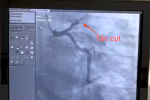 Hình ảnh cho thấy, bệnh nhân bị nhồi máu cơ tim, gây tắc nghẽn hoàn toàn từ đoạn 1, động mạch liên thất trước. Ảnh: BVCC 