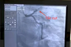 Hình ảnh cho thấy, bệnh nhân bị nhồi máu cơ tim, gây tắc nghẽn hoàn toàn từ đoạn 1, động mạch liên thất trước. Ảnh: BVCC