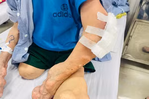 Sau 3 ngày điều trị tích cực, bệnh nhân thấy bớt đau, tình trạng sưng đỏ tại các khớp cũng được cải thiện. Ảnh: BVCC