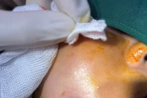 Bệnh nhân có lỗ rò chảy mủ ở niêm mạc má tại vị trí thắt đồng tiền sau thực hiện tạo hình. Ảnh: BVCC