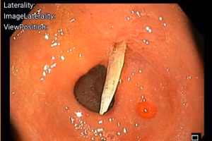 Hình ảnh dị vật qua nội soi. Ảnh: Bệnh viện Đa khoa tỉnh Thanh Hóa