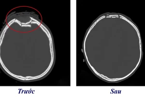 Hình ảnh vùng sọ não bị lún của trẻ trước và sau khi phẫu thuật. Ảnh: BVCC 