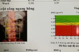 Kết quả đo loãng xương bằng phương pháp DEXA của một bệnh nhân bị biến chứng loãng xương do tự ý dùng corticoid kéo dài. Ảnh: BVCC