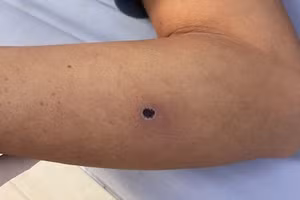 Giun rồng ký sinh dưới da bệnh nhân. Ảnh: TTYT