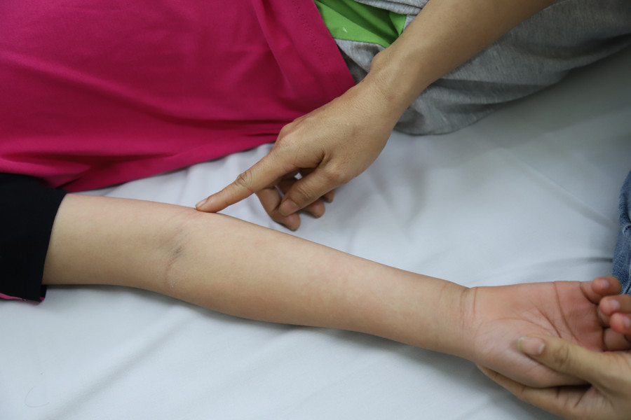 Mẩn đỏ ngứa là một trong những dấu hiệu phổ biến và điển hình của bệnh sốt xuất huyết. img-9998.jpg