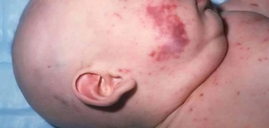 Triệu chứng của bệnh viêm não mô cầu. 