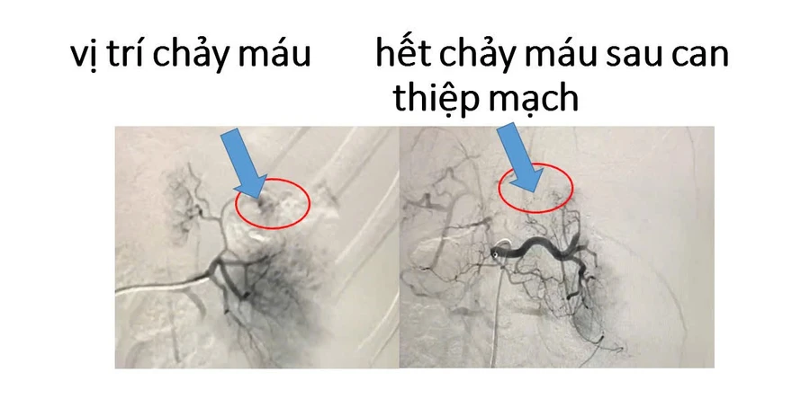 Hình ảnh chụp mạch máu xóa nền DSA hệ động mạch lách, (Ảnh: BVCC)